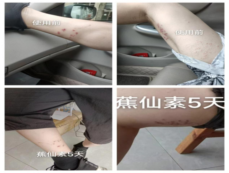 分享案例丨带状疱疹剧痛难消？蕉仙素助力患者5天逆袭