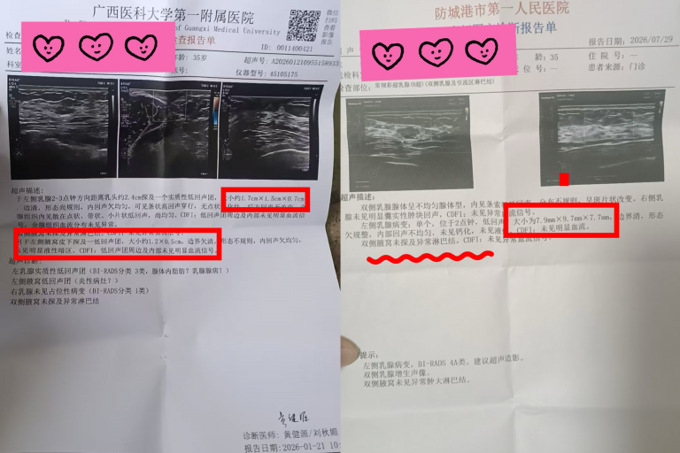 卵巢恶性肿瘤多发转移